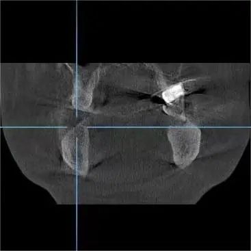 「黑科技」拉满看牙体验!拔牙、种牙『笑』着完成