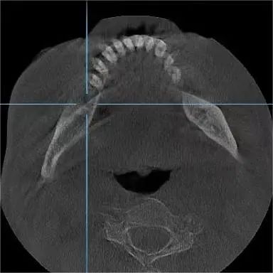 「黑科技」拉满看牙体验!拔牙、种牙『笑』着完成