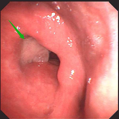 长期嗓子嘶哑，竟是喉癌的「摩斯密码」