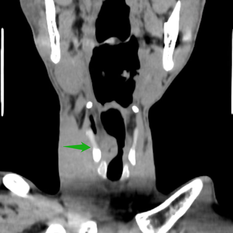 长期嗓子嘶哑，竟是喉癌的「摩斯密码」