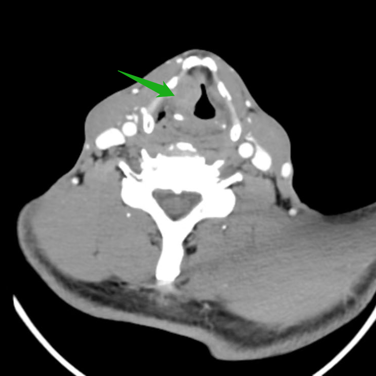 长期嗓子嘶哑，竟是喉癌的「摩斯密码」