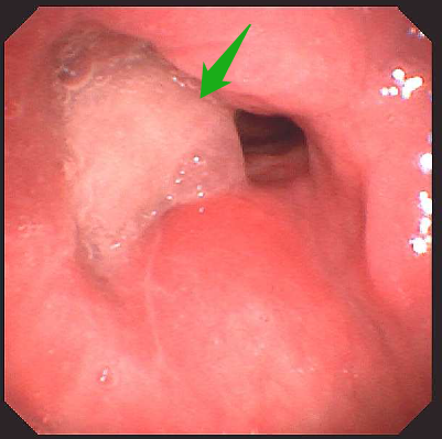 长期嗓子嘶哑，竟是喉癌的「摩斯密码」