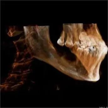 「黑科技」拉满看牙体验!拔牙、种牙『笑』着完成