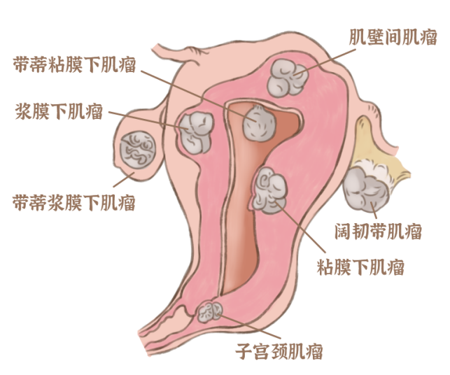 5 个女性就有 1 个中招！子宫肌瘤真的可怕吗？