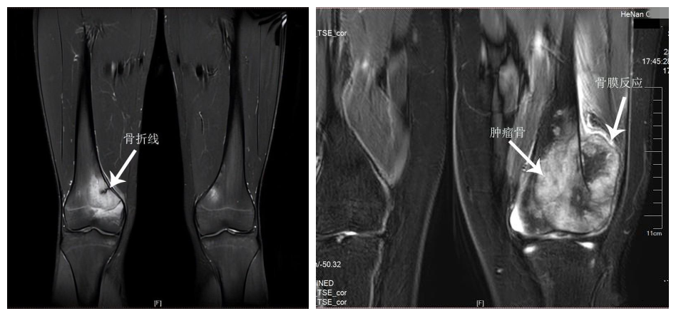 警惕儿童疲劳骨折，避免误诊骨肉瘤