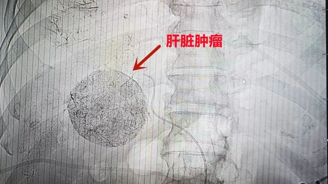医生医事：肝癌破裂大出血 生命垂危
