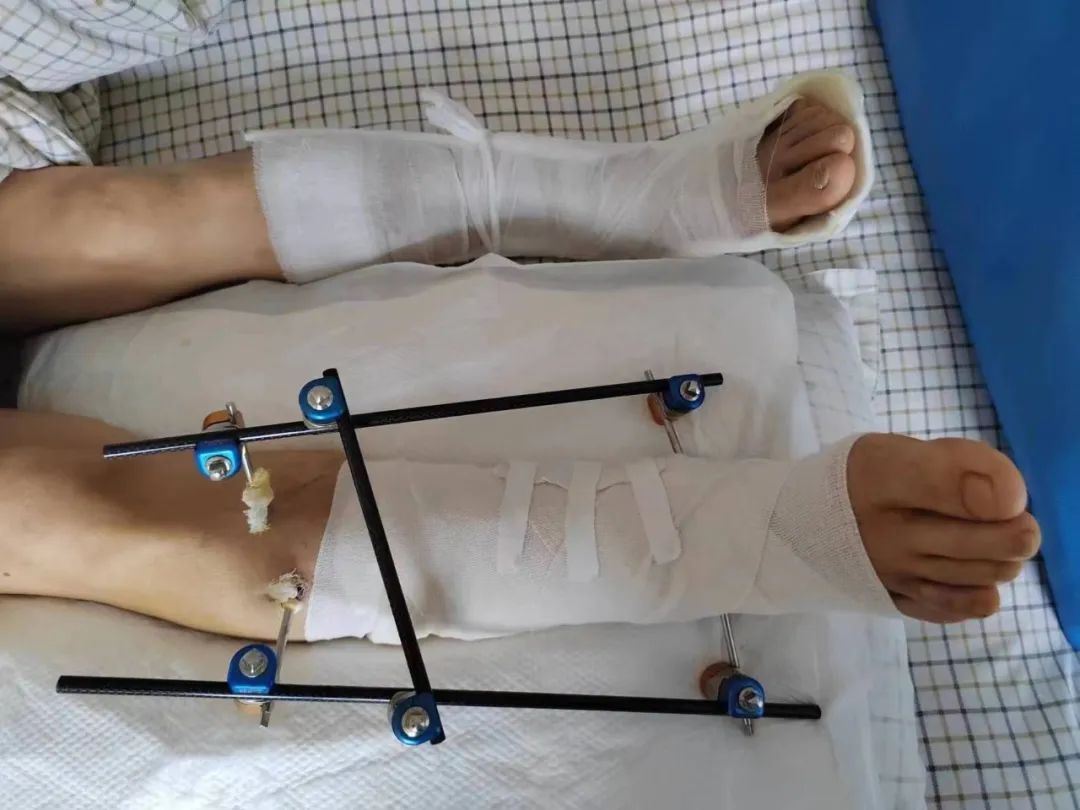 不要小瞧 3 米高空作业，一脚踩空摔的「骨头都裸露出来了」！