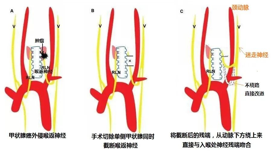 新技术！河南省肿瘤医院专家巧破复杂甲状腺癌术后失声难题
