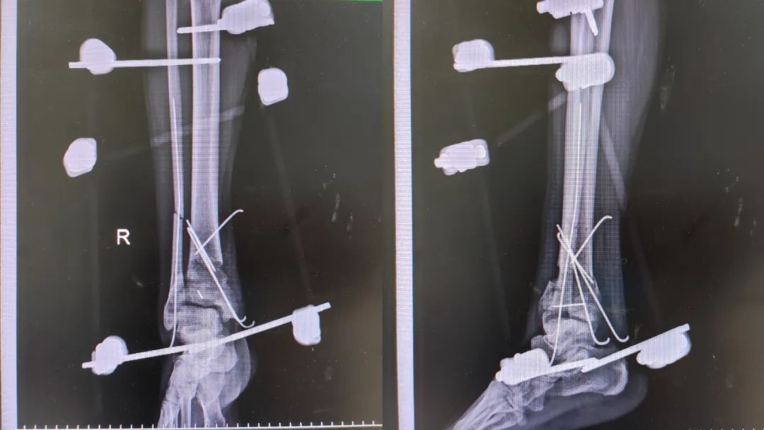 不要小瞧 3 米高空作业，一脚踩空摔的「骨头都裸露出来了」！