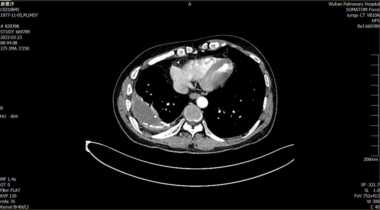 26 年 「钉子户」菌团在患者体内筑「石屋」