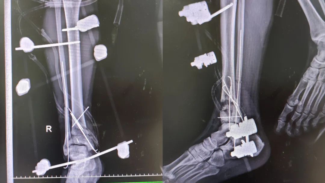 不要小瞧 3 米高空作业，一脚踩空摔的「骨头都裸露出来了」！