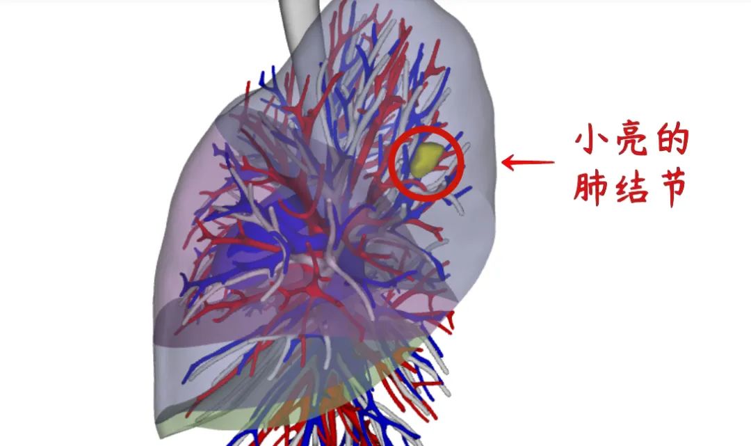 体检查到肺结节？别慌！按这 3 步走评估风险性