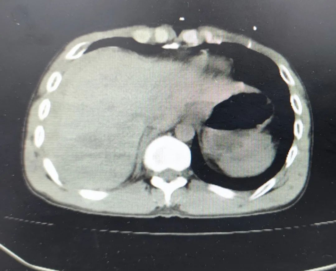 NEJM深度综述：肝细胞性肝癌_原发性肝癌_肝细胞癌_医脉通