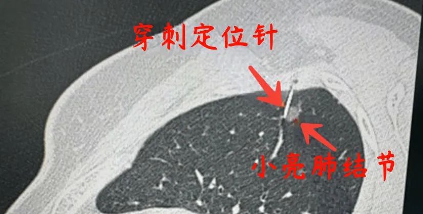 体检查到肺结节？别慌！按这 3 步走评估风险性