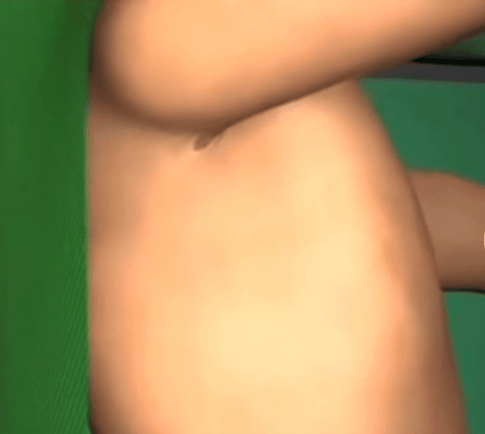 体检查到肺结节？别慌！按这 3 步走评估风险性