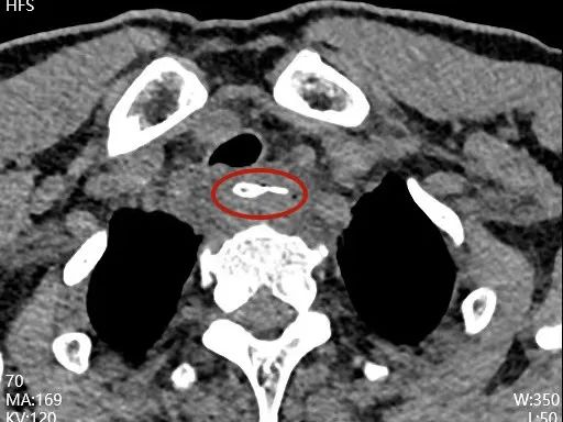 惊！3.5 厘米的鸭骨刺破食管，命悬一线……