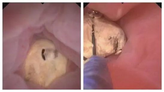 延大附院开展阑尾炎内镜治疗 填补陕北地区空白