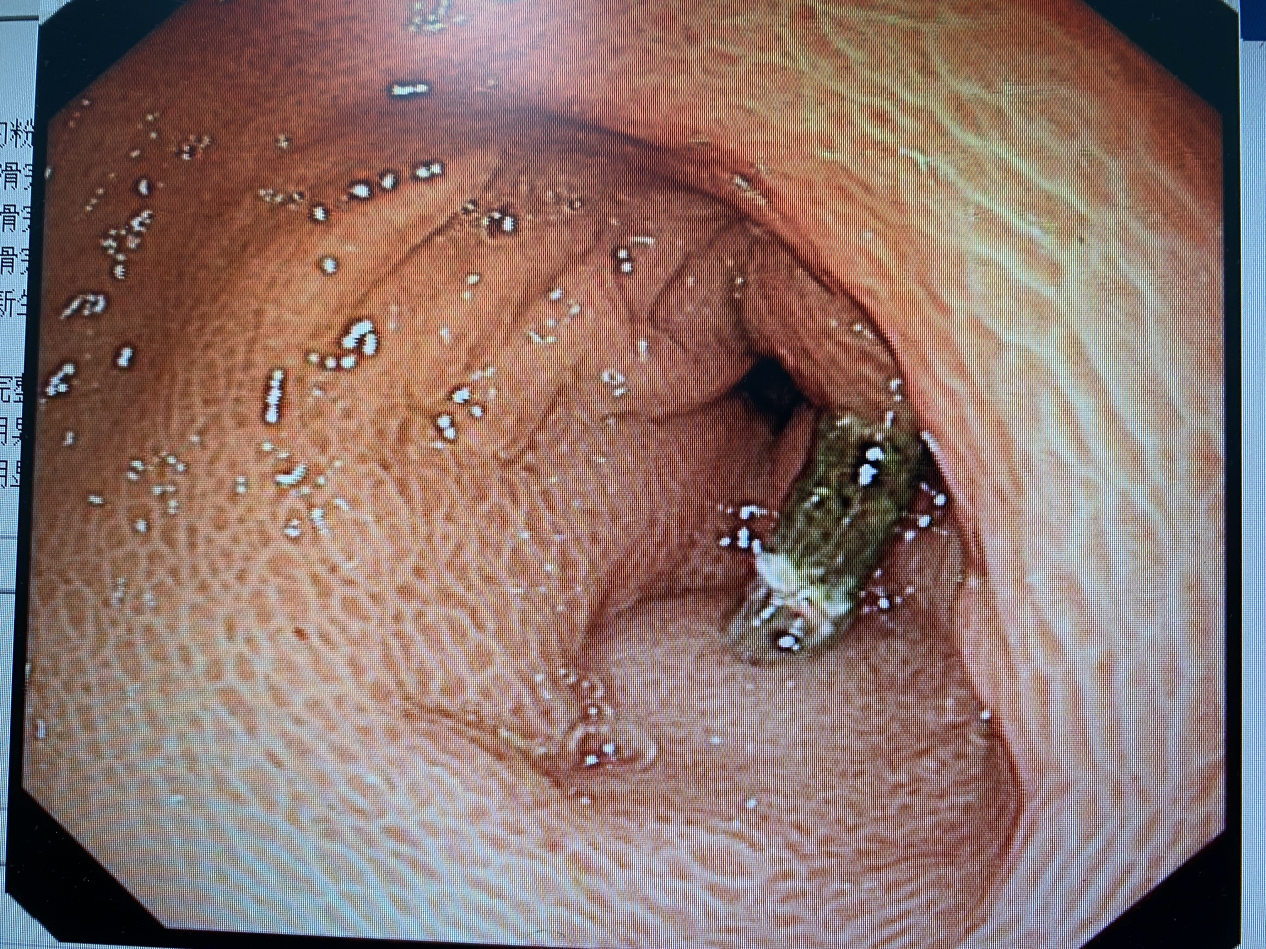 一颗枣核,差点给肚子穿个洞!干饭不当,小心没命!