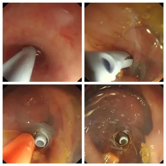 延大附院开展阑尾炎内镜治疗 填补陕北地区空白