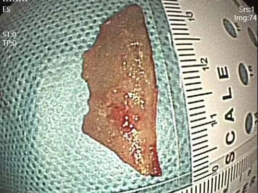 惊！3.5 厘米的鸭骨刺破食管，命悬一线……