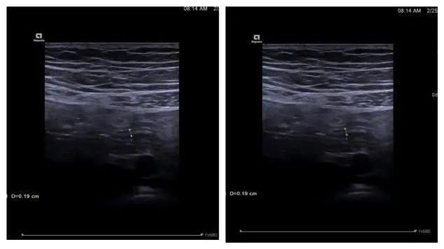 延大附院开展阑尾炎内镜治疗 填补陕北地区空白