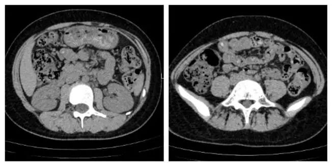 延大附院开展阑尾炎内镜治疗 填补陕北地区空白