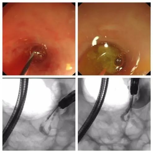延大附院开展阑尾炎内镜治疗 填补陕北地区空白