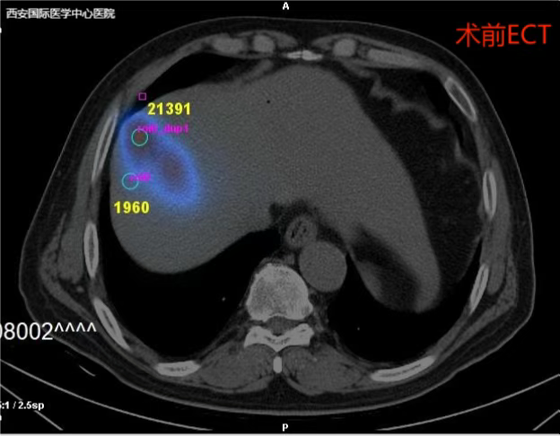 重磅！西安国际医学中心医院首例钇-90 微球治疗肝癌手术成功实施！