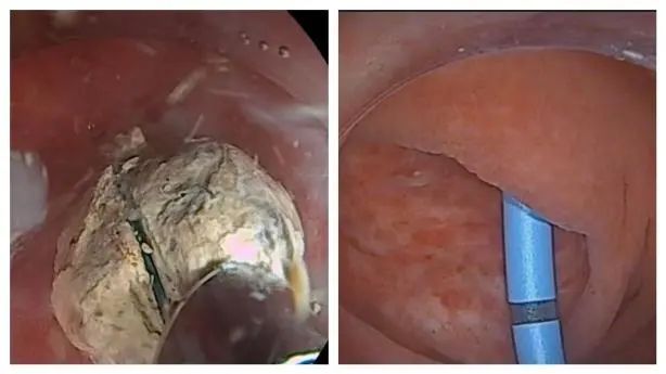 延大附院开展阑尾炎内镜治疗 填补陕北地区空白
