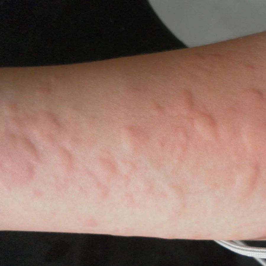 荨麻疹和补钙有什么关系？