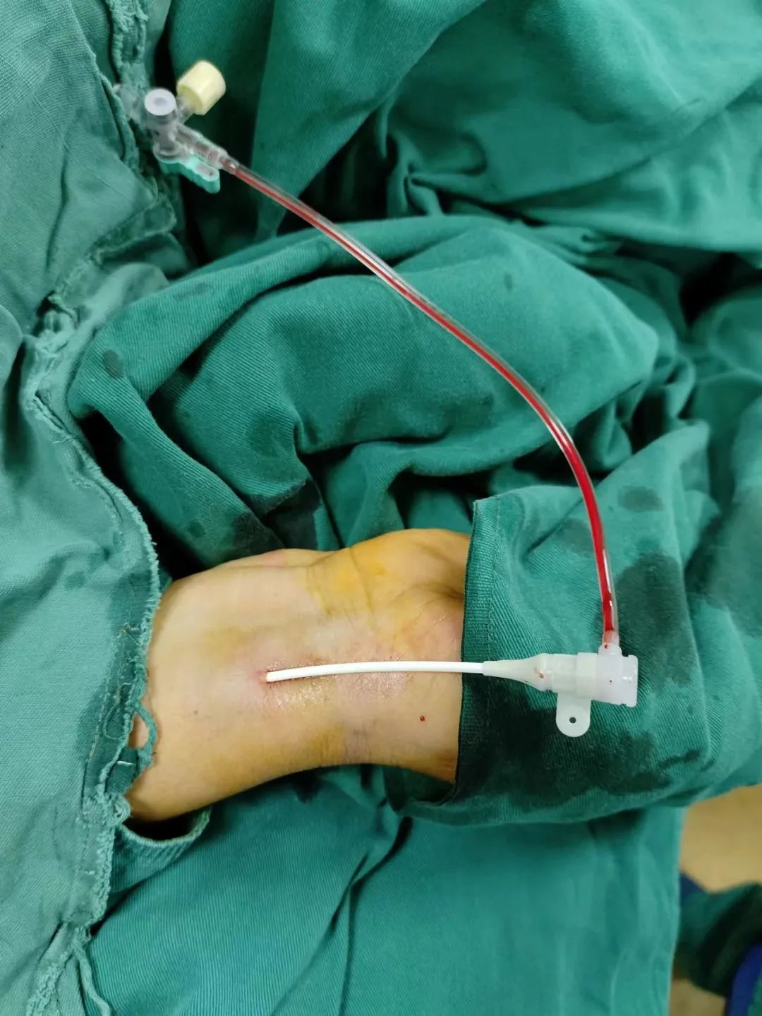 经桡动脉入路全脑血管造影术,让患者术后「不躺平」!