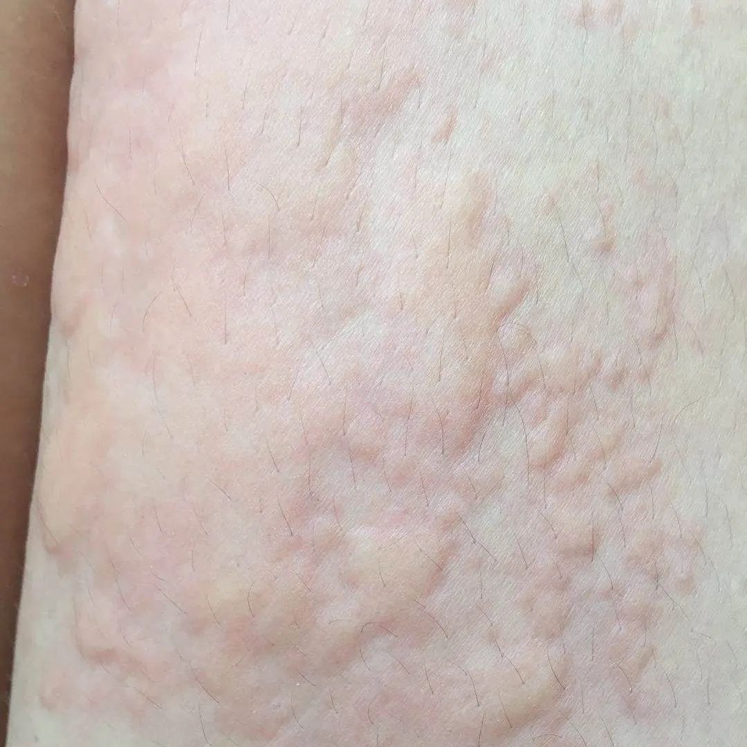 荨麻疹和补钙有什么关系？