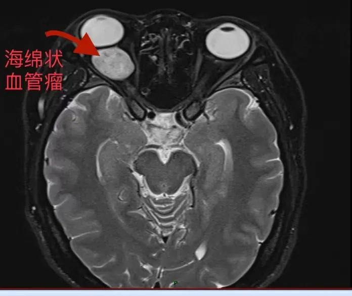 发现眼睛变大  原是眼眶内长了肿瘤