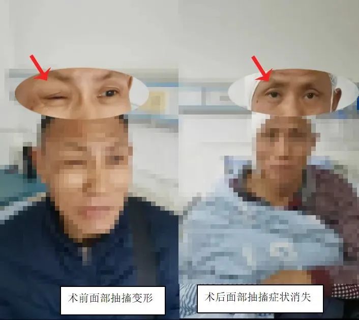 八里湖总院神经外科成功解决患者三年面部不自主抽搐的痛苦