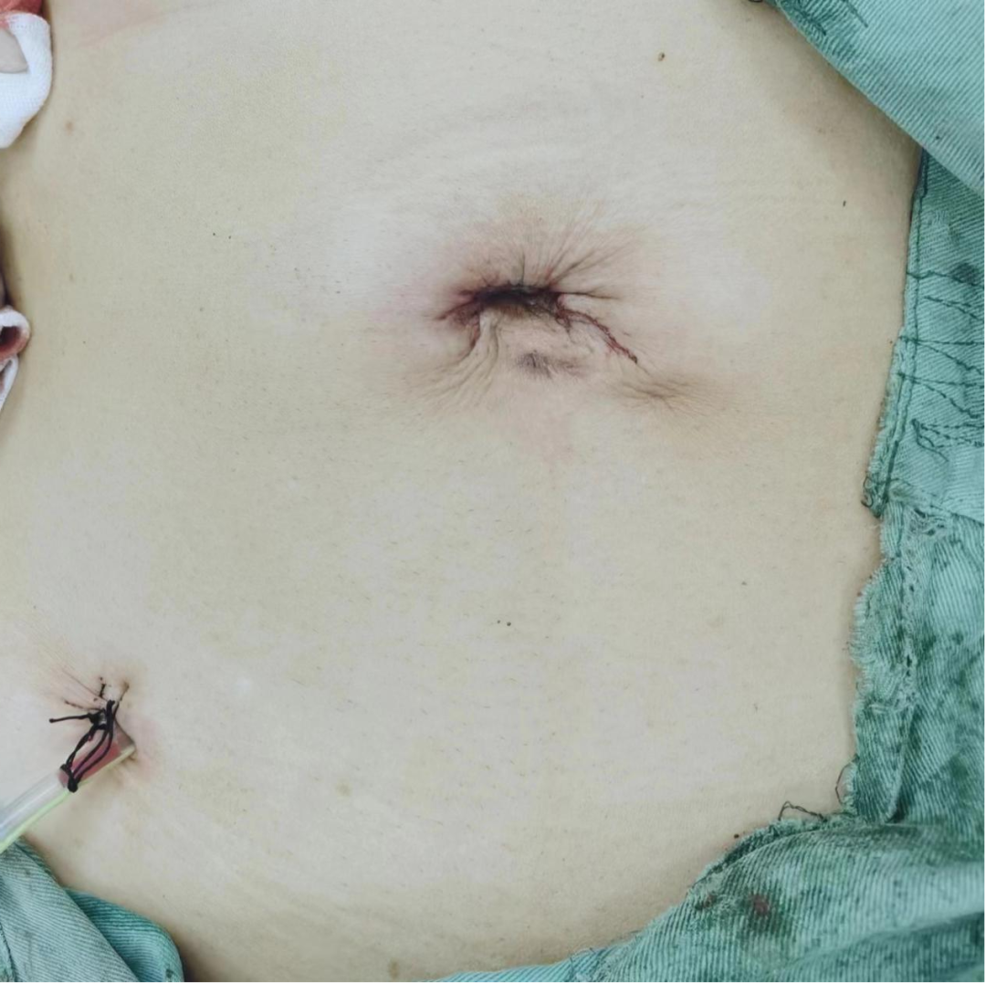 广西中医药大学第一附属医院仙葫院区普通外科·肛肠科顺利完成一例高难度腹腔镜单孔+（两孔法）直肠癌根治术