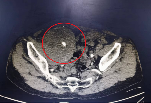 广西壮族自治区南溪山医院成功为一女子切除 15 厘米巨大盆腔肿瘤