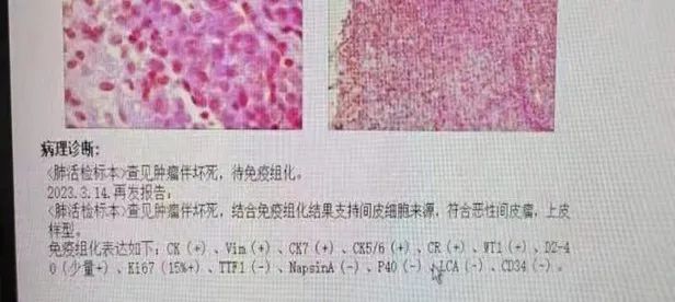 高尚病例：胸膜恶性间皮瘤一例