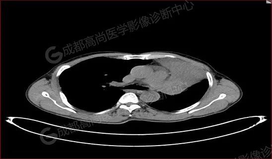 高尚病例：胸膜恶性间皮瘤一例