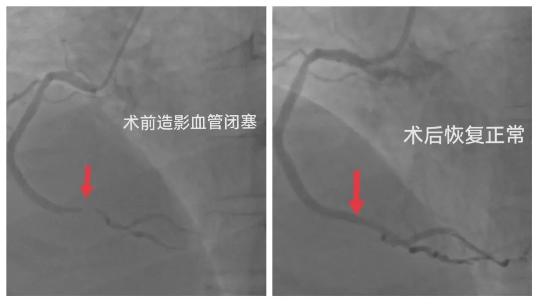 停跳 3 分钟！28 岁女孩突发心梗，尽快戒掉这些坏毛病