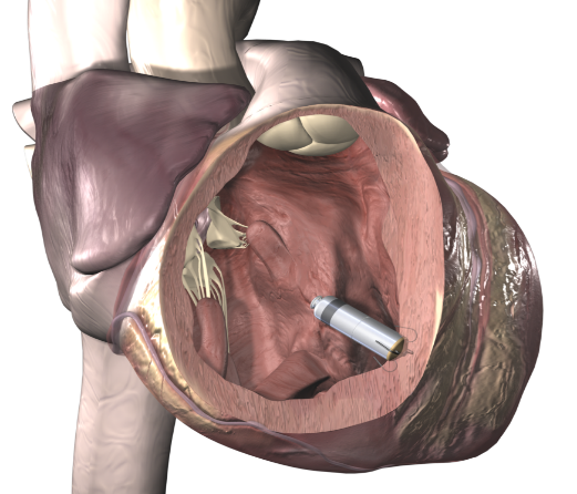 湖州市中心医院完成一例特殊无导线起搏器植入术