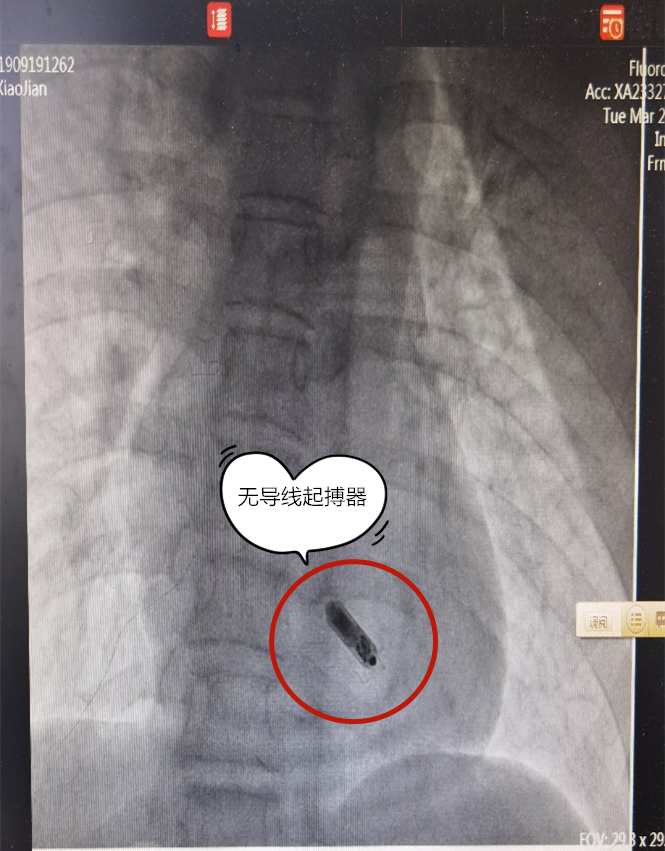 湖州市中心医院完成一例特殊无导线起搏器植入术