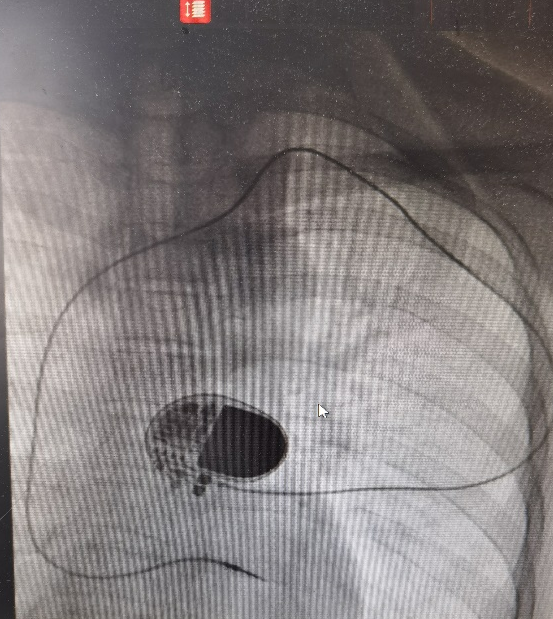 湖州市中心医院完成一例特殊无导线起搏器植入术