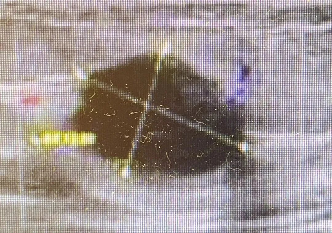 25 岁中招乳腺癌!大胸、小胸,哪种胸更容易患癌