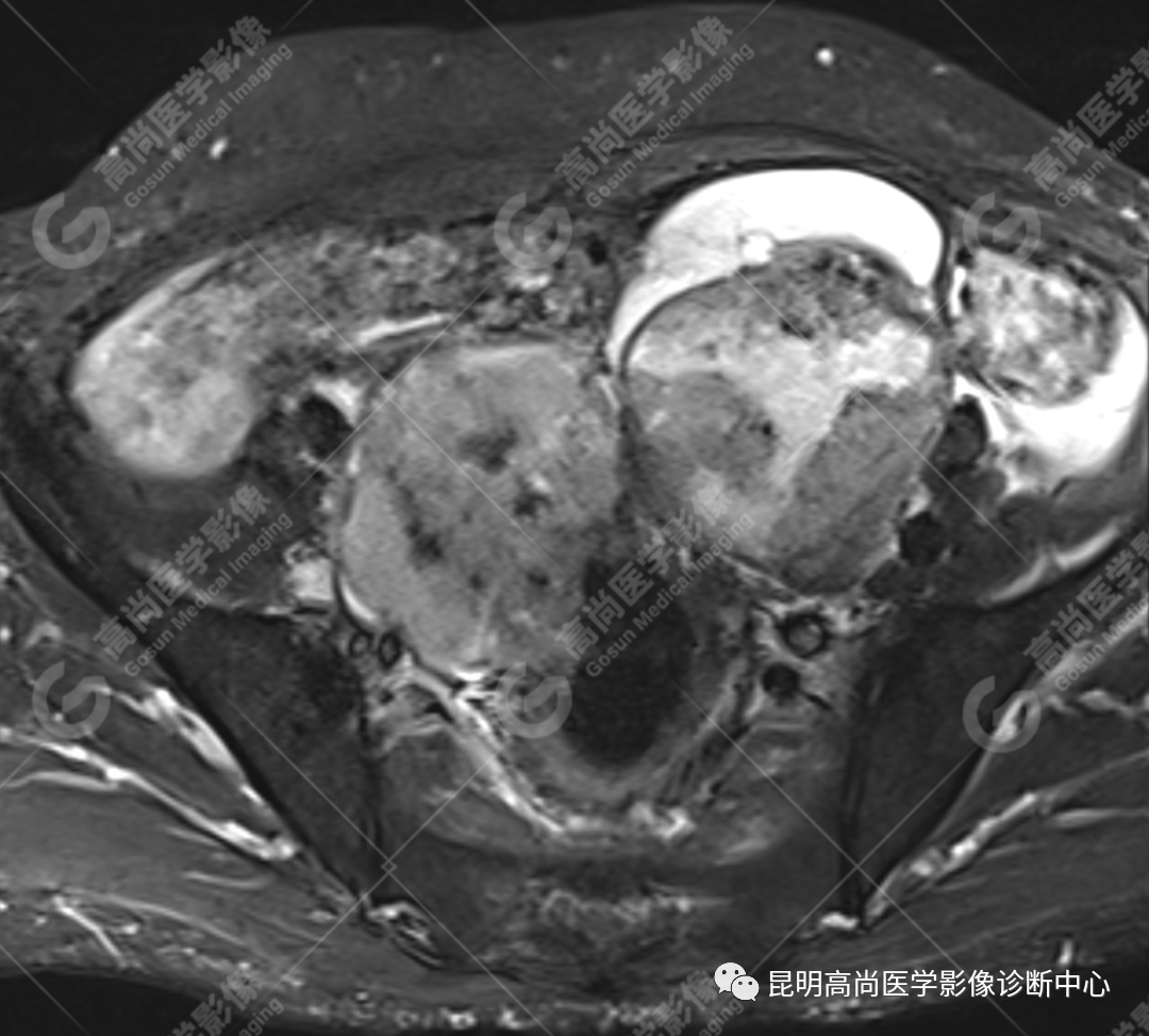 高尚病例:子宫癌肉瘤一例