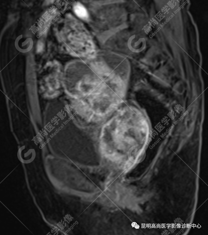高尚病例:子宫癌肉瘤一例