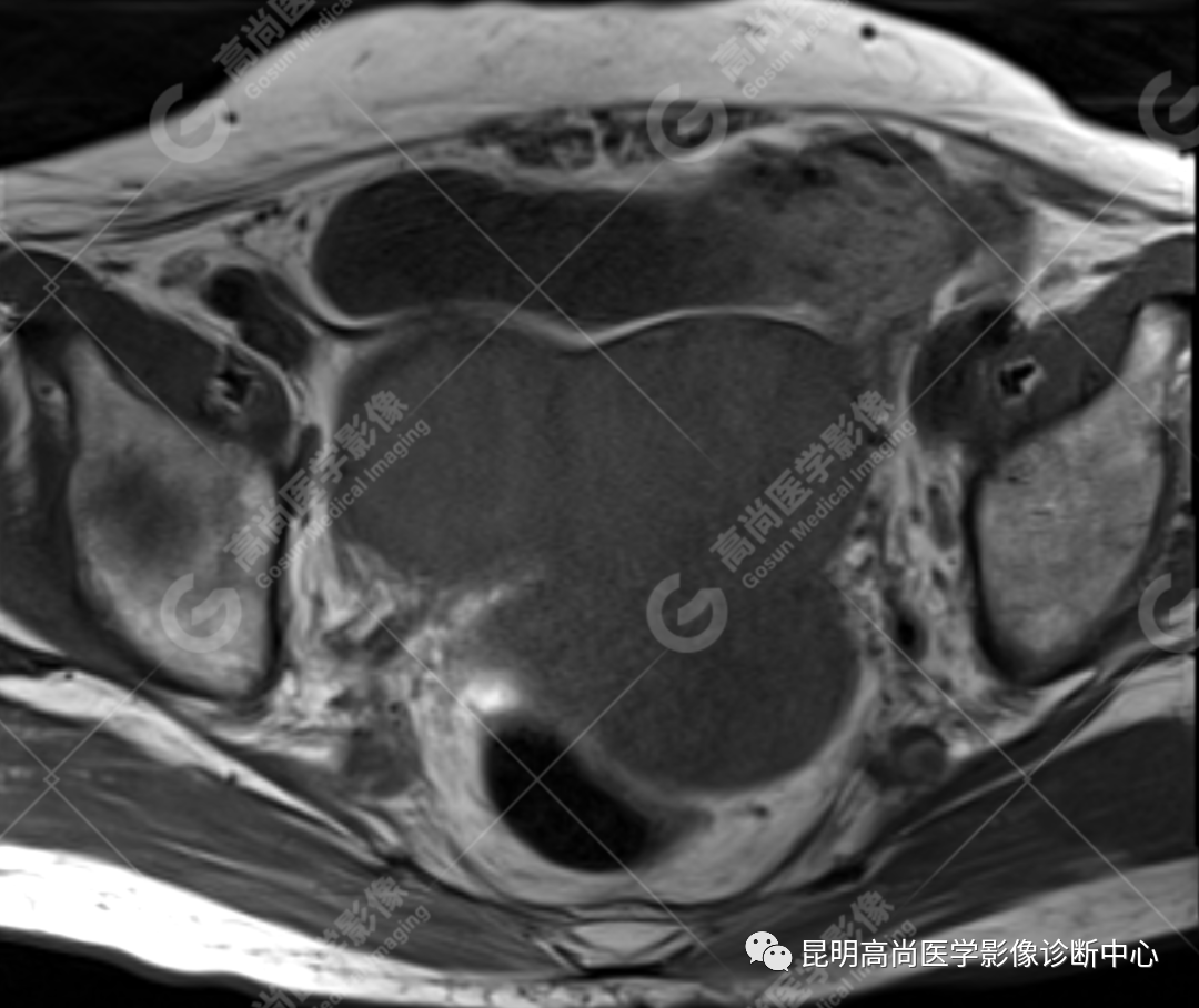 高尚病例:子宫癌肉瘤一例