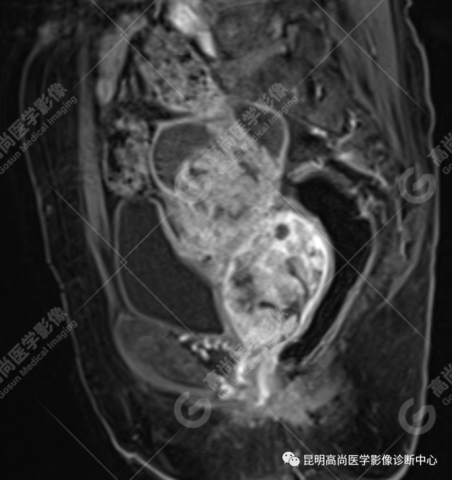 高尚病例:子宫癌肉瘤一例