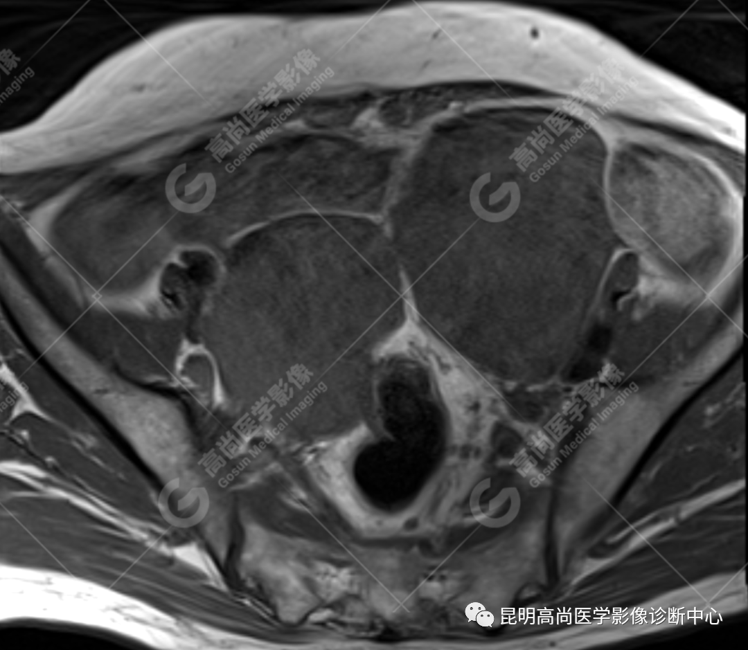 高尚病例:子宫癌肉瘤一例
