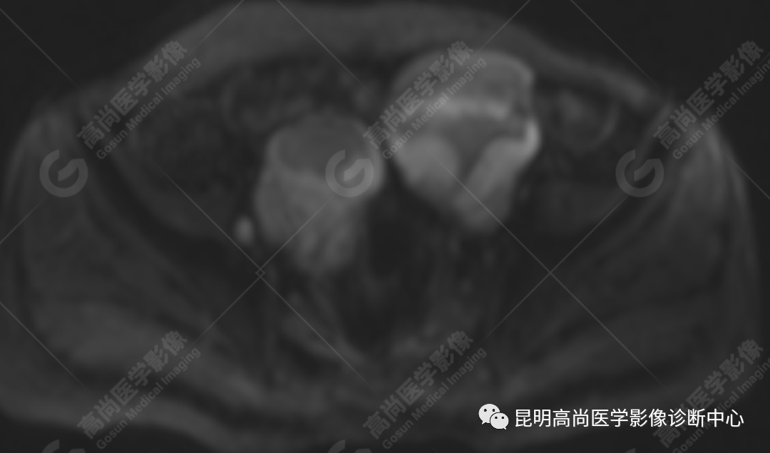 高尚病例:子宫癌肉瘤一例