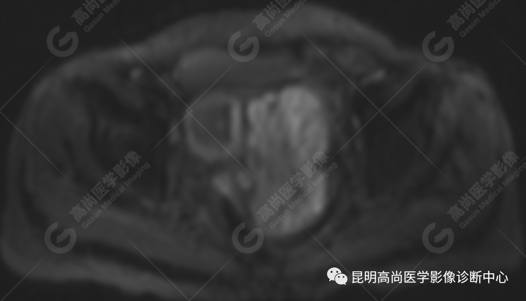 高尚病例:子宫癌肉瘤一例